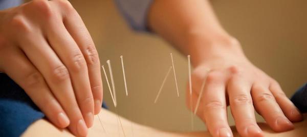 Acupunctuur_Timmermans_Waalwijk_Homepage_acupuncture